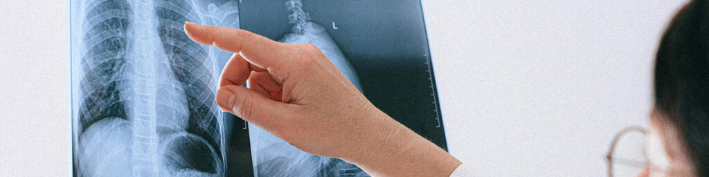 Spinal Injury