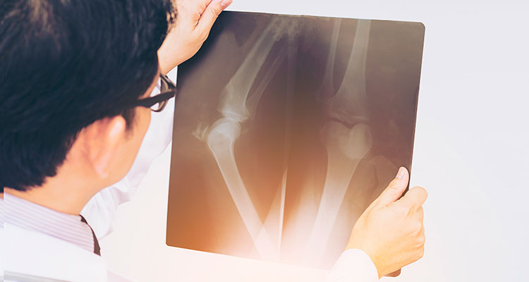 How Broken Bones Are Valued in Injury Settlements